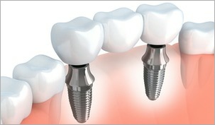 Bridge on Implants