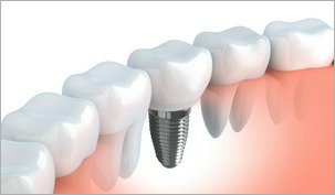 Single Implant at low jaw
